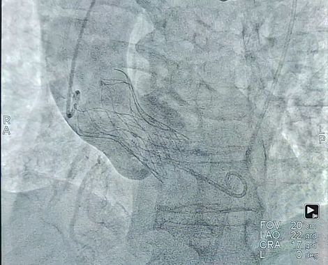 Angiografia al termine dell'impianto della protesi valvolare aortica