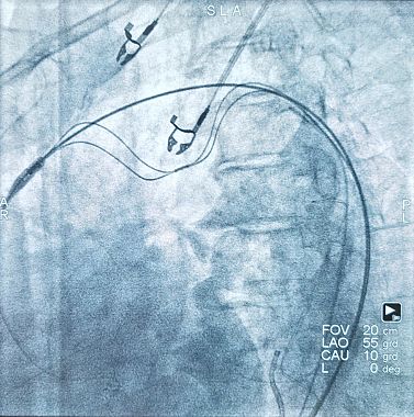 Angiografia che mostra il posizionamento del filtro embolico tra l'aorta ascendente e l'aorta discendente 