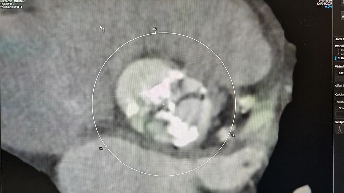 Immagine angioTAC della valvola aortica bicuspide di uno dei pazienti
